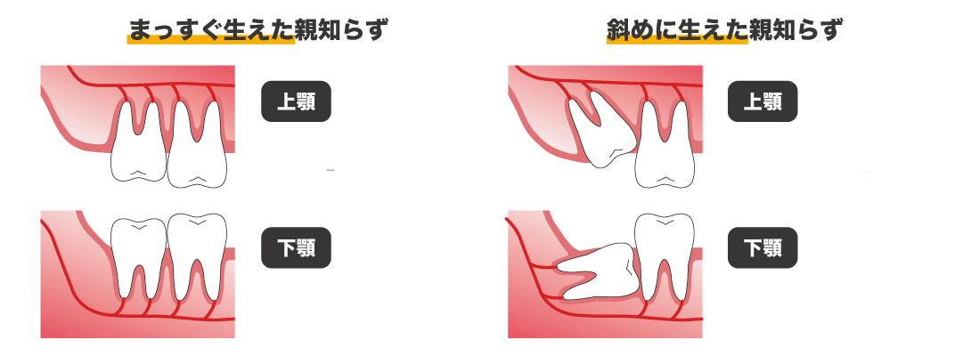 親知らずの抜歯｜橋本の翼歯科口腔クリニック